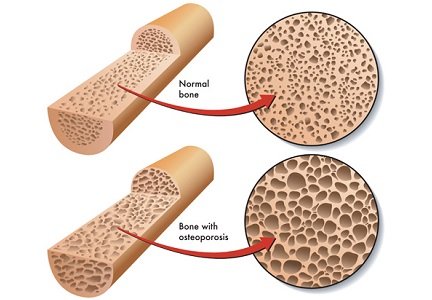 Tips to reduce your risk of osteoporosis