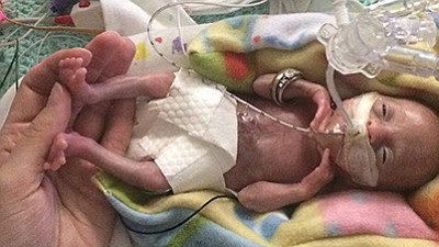 Born before 22 weeks, ‘most premature’ baby is now thriving